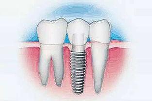 蘇州種植牙醫院哪家好？2025靠譜評價好的種植口腔排名公布